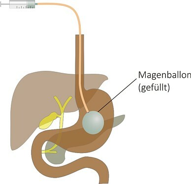 Magenballon2